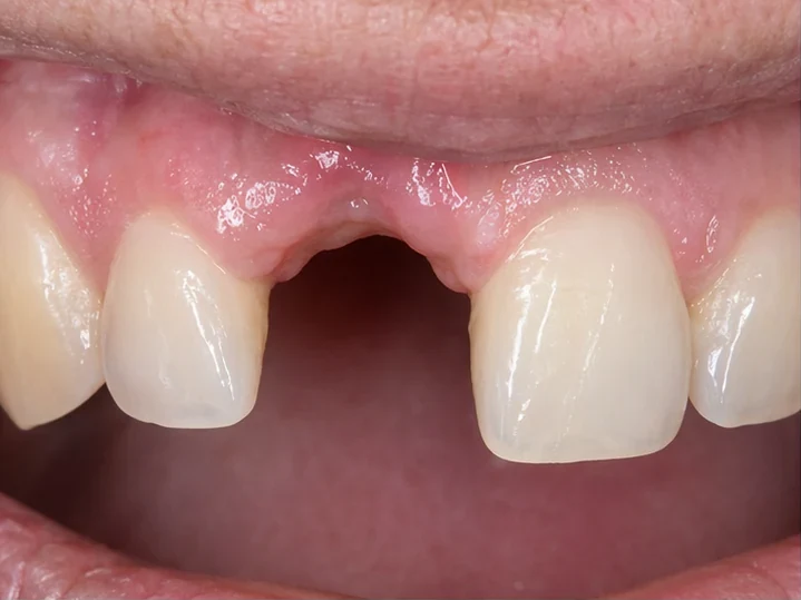 Vista frontal: diente anterior ausente, corona en DentiFlex, inserción entre los dientes adyacentes y resultado