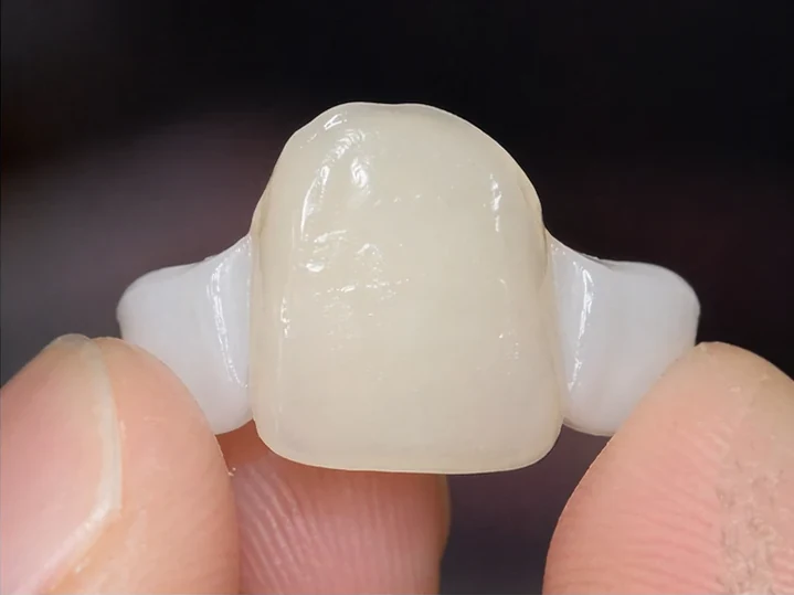 Vista frontal: diente anterior ausente, corona en DentiFlex, inserción entre los dientes adyacentes y resultado