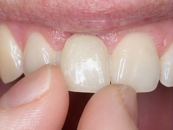 Vista frontal: diente anterior ausente, corona en DentiFlex, inserción entre los dientes adyacentes y resultado