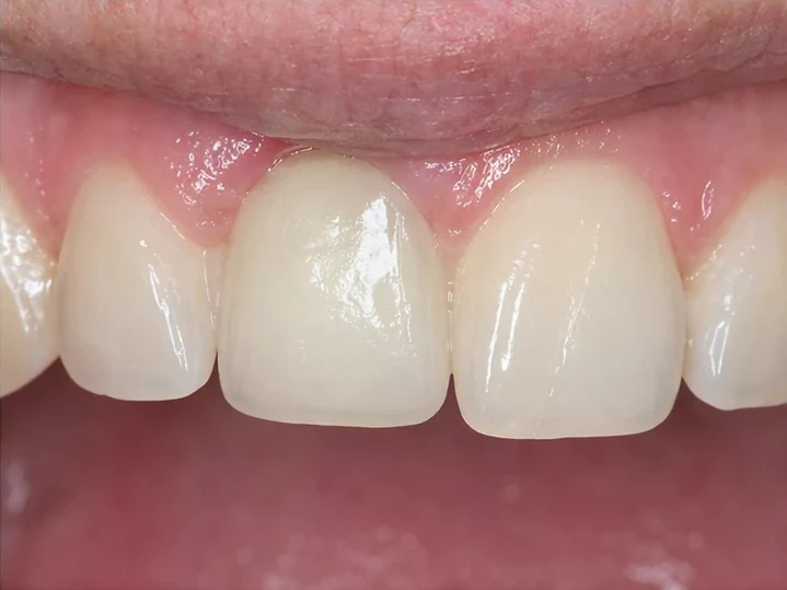 Vista frontal: diente anterior ausente, corona en DentiFlex, inserción entre los dientes adyacentes y resultado