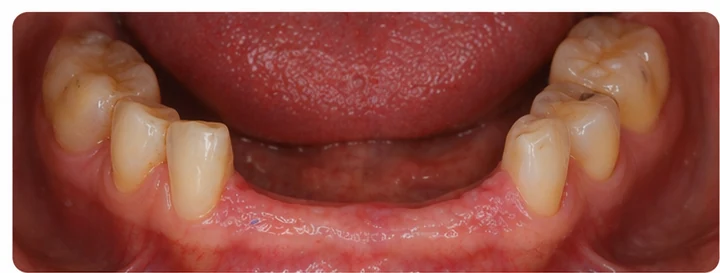 Procedimiento visual para dos premolares y una muela superiores: principio de colocación del puente Denticor con los nuevos dientes y su ajuste a los dientes adyacentes