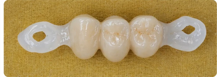 Procedimiento visual para dos premolares y una muela superiores: principio de colocación del puente Denticor con los nuevos dientes y su ajuste a los dientes adyacentes