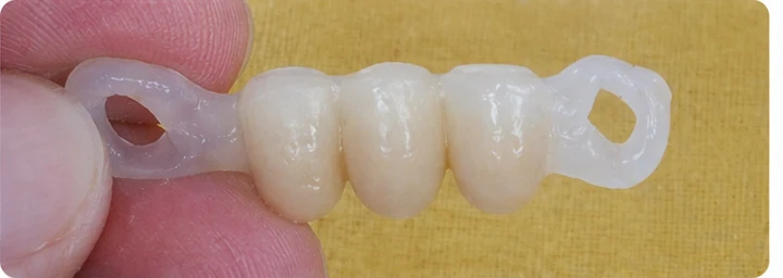 Procedimiento visual para dos premolares y una muela superiores: principio de colocación del puente Denticor con los nuevos dientes y su ajuste a los dientes adyacentes