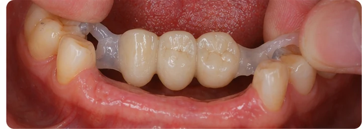 Procedimiento visual para dos premolares y una muela superiores: principio de colocación del puente Denticor con los nuevos dientes y su ajuste a los dientes adyacentes