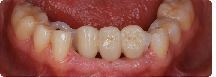 Procedimiento visual para dos premolares y una muela superiores: principio de colocación del puente Denticor con los nuevos dientes y su ajuste a los dientes adyacentes