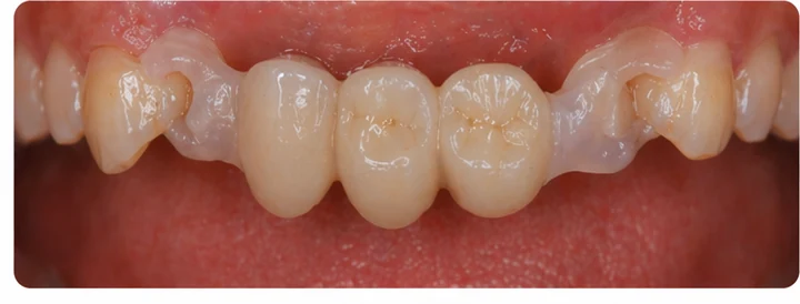 Procedimiento visual para dos premolares y una muela superiores: principio de colocación del puente Denticor con los nuevos dientes y su ajuste a los dientes adyacentes