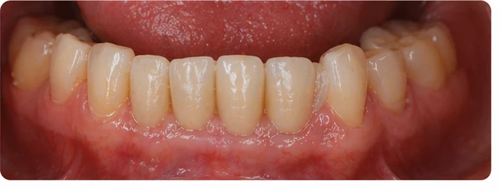 Procedimiento visual para dos premolares y una muela superiores: principio de colocación del puente Denticor con los nuevos dientes y su ajuste a los dientes adyacentes