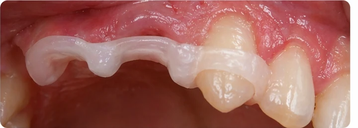 Demostración de ajuste del Denticor: colocación del recambio y modelado de su soporte DentiFlex · 6