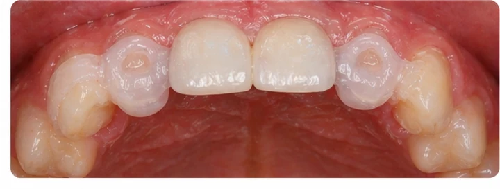 Demostración de ajuste del Denticor: colocación del recambio y modelado de su soporte DentiFlex · 7