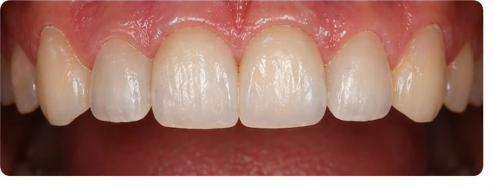 Demostración de ajuste del Denticor: colocación del recambio y modelado de su soporte DentiFlex · 8