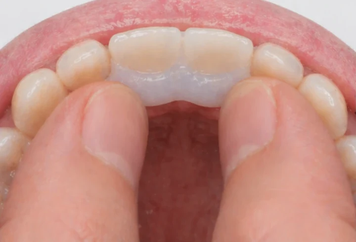 Denticor para los dos incisivos centrales superiores: vista posterior desde el paladar; forma del puente y ajuste detrás de los nuevos dientes