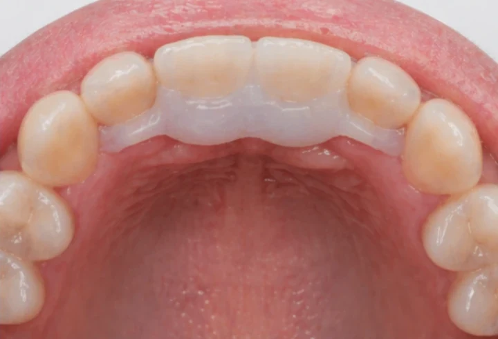 Denticor para los dos incisivos centrales superiores: vista posterior desde el paladar; forma del puente y ajuste detrás de los nuevos dientes