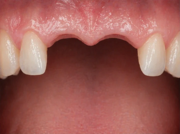 Denticor para los dos incisivos centrales superiores —vista frontal—: hueco, prótesis preparada, colocación y resultado