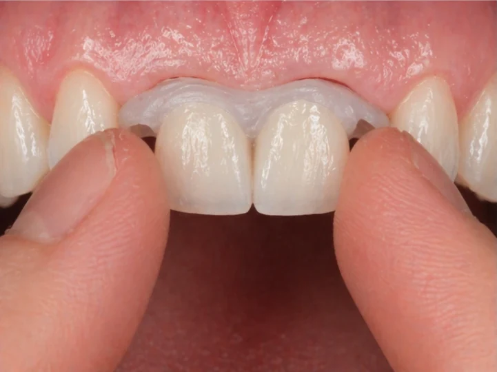 Denticor para los dos incisivos centrales superiores —vista frontal—: hueco, prótesis preparada, colocación y resultado
