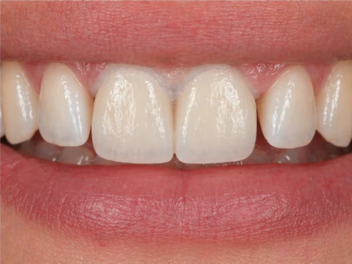 Denticor para los dos incisivos centrales superiores —vista frontal—: hueco, prótesis preparada, colocación y resultado