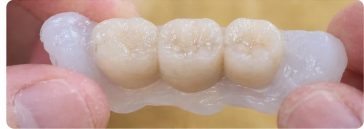 Guía visual: faltan tres dientes superiores traseros