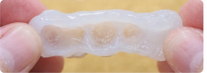 Guía visual: faltan tres dientes superiores traseros