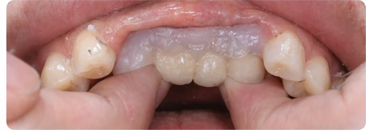 Guía visual: faltan tres dientes superiores traseros