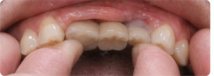 Guía visual: faltan tres dientes superiores traseros