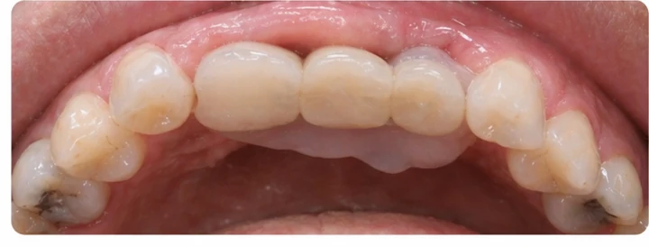 Guía visual: faltan tres dientes superiores traseros