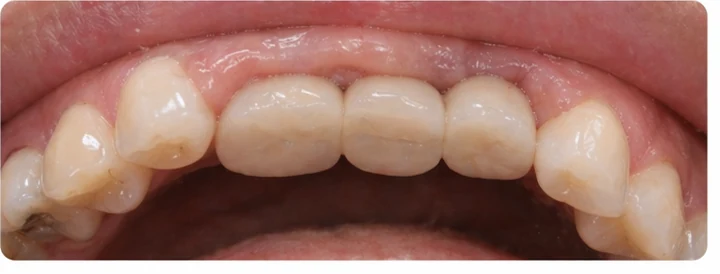 Guía visual: faltan tres dientes superiores traseros