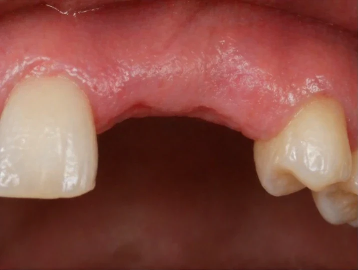Sustitución con Denticor del incisivo lateral y el canino superiores: vista frontal, colocación del puente y resultado