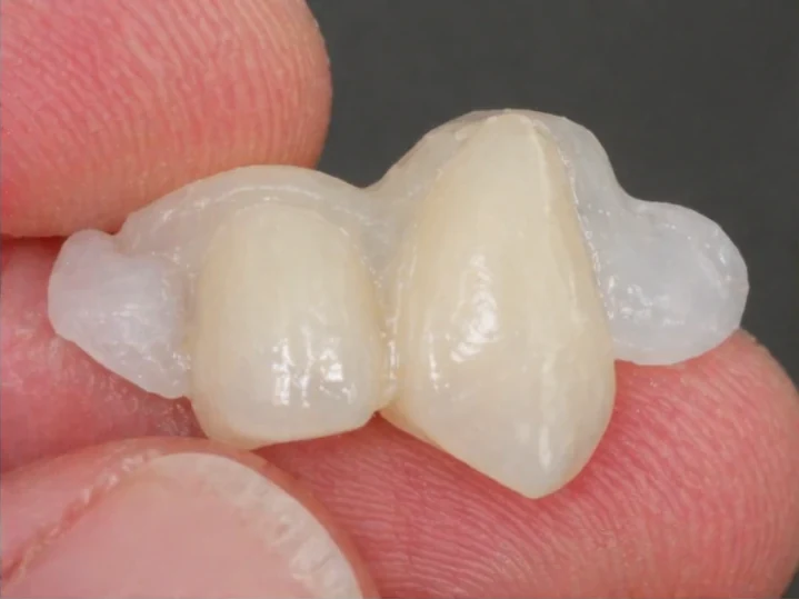 Sustitución con Denticor del incisivo lateral y el canino superiores: vista frontal, colocación del puente y resultado