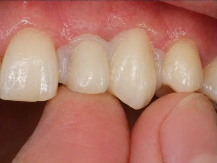Sustitución con Denticor del incisivo lateral y el canino superiores: vista frontal, colocación del puente y resultado