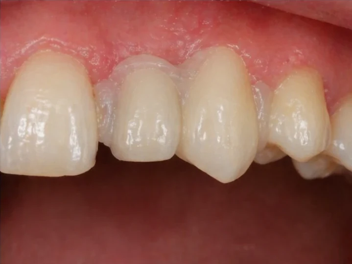 Sustitución con Denticor del incisivo lateral y el canino superiores: vista frontal, colocación del puente y resultado