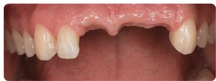 Demostración de ajuste del Denticor: colocación del recambio y modelado de su soporte DentiFlex · 1