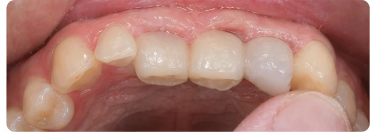 Demostración de ajuste del Denticor: colocación del recambio y modelado de su soporte DentiFlex · 5