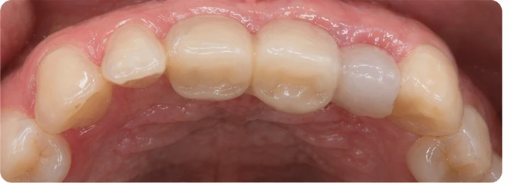 Demostración de ajuste del Denticor: colocación del recambio y modelado de su soporte DentiFlex · 6