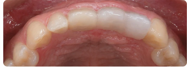 Demostración de ajuste del Denticor: colocación del recambio y modelado de su soporte DentiFlex · 7