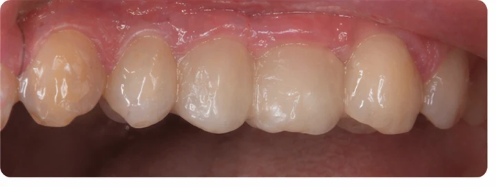 Demostración de ajuste del Denticor: colocación del recambio y modelado de su soporte DentiFlex · 8