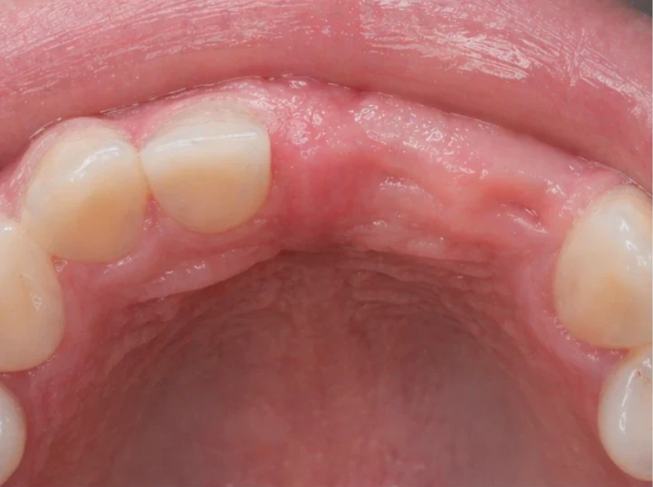 Denticor para el incisivo central superior y el lateral: vista posterior desde el paladar: forma del puente y ajuste tras los dientes nuevos