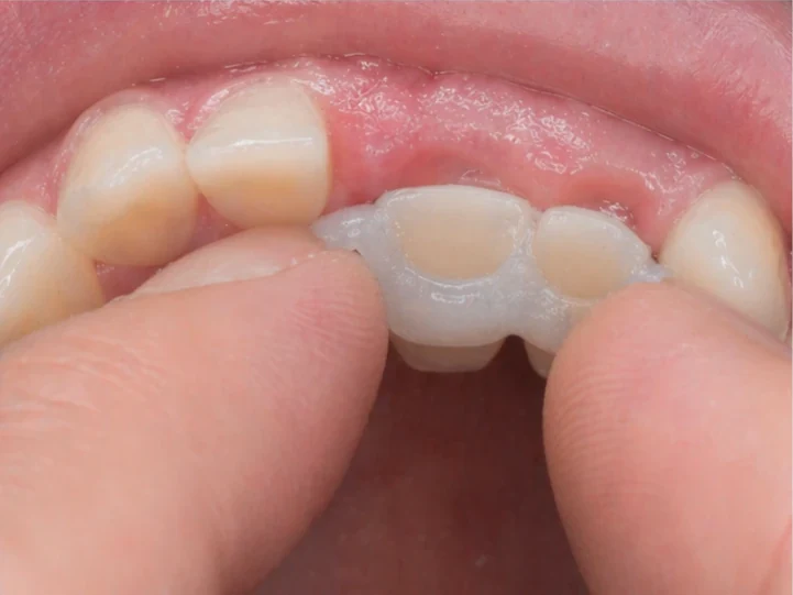 Denticor para el incisivo central superior y el lateral: vista posterior desde el paladar: forma del puente y ajuste tras los dientes nuevos