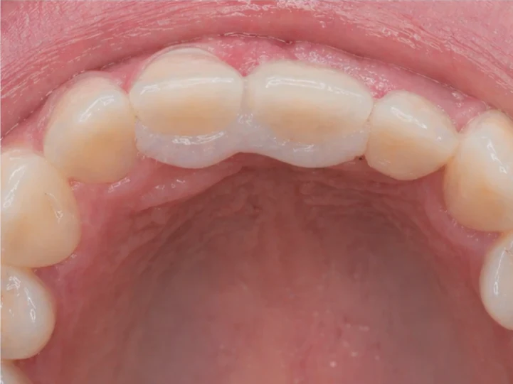Denticor para el incisivo central superior y el lateral: vista posterior desde el paladar: forma del puente y ajuste tras los dientes nuevos
