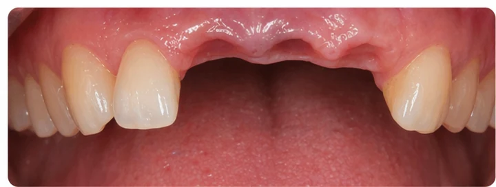 Procedimiento visual para tres dientes adyacentes en el arco superior: principio de colocación del puente Denticor con los nuevos dientes y su ajuste a los dientes circundantes