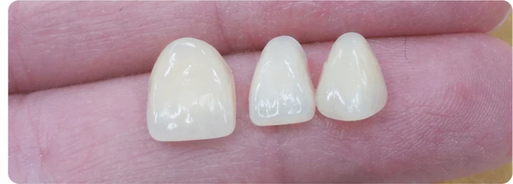 Procedimiento visual para tres dientes adyacentes en el arco superior: principio de colocación del puente Denticor con los nuevos dientes y su ajuste a los dientes circundantes