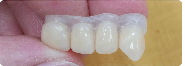 Procedimiento visual para tres dientes adyacentes en el arco superior: principio de colocación del puente Denticor con los nuevos dientes y su ajuste a los dientes circundantes