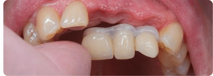 Procedimiento visual para tres dientes adyacentes en el arco superior: principio de colocación del puente Denticor con los nuevos dientes y su ajuste a los dientes circundantes