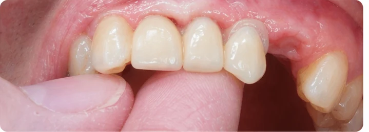 Procedimiento visual para tres dientes adyacentes en el arco superior: principio de colocación del puente Denticor con los nuevos dientes y su ajuste a los dientes circundantes