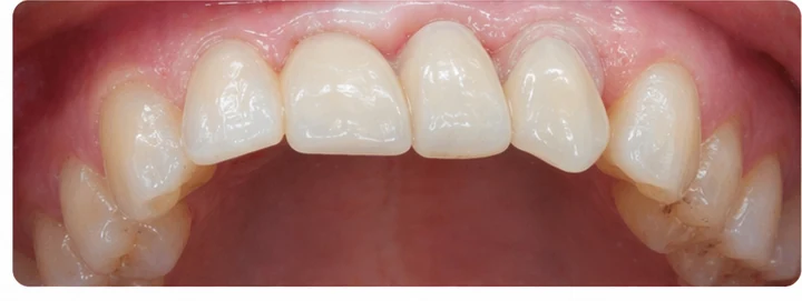 Procedimiento visual para tres dientes adyacentes en el arco superior: principio de colocación del puente Denticor con los nuevos dientes y su ajuste a los dientes circundantes