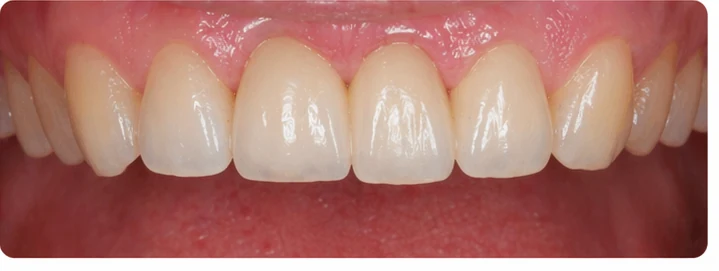 Procedimiento visual para tres dientes adyacentes en el arco superior: principio de colocación del puente Denticor con los nuevos dientes y su ajuste a los dientes circundantes