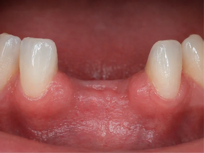 Denticor: sustitución rápida de dos incisivos inferiores: espacio, puente DentiFlex preparado con dos dientes, colocación como una pieza única y resultado