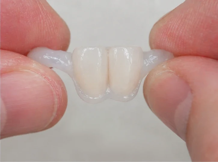 Denticor: sustitución rápida de dos incisivos inferiores: espacio, puente DentiFlex preparado con dos dientes, colocación como una pieza única y resultado