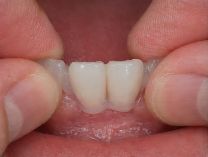 Denticor: sustitución rápida de dos incisivos inferiores: espacio, puente DentiFlex preparado con dos dientes, colocación como una pieza única y resultado