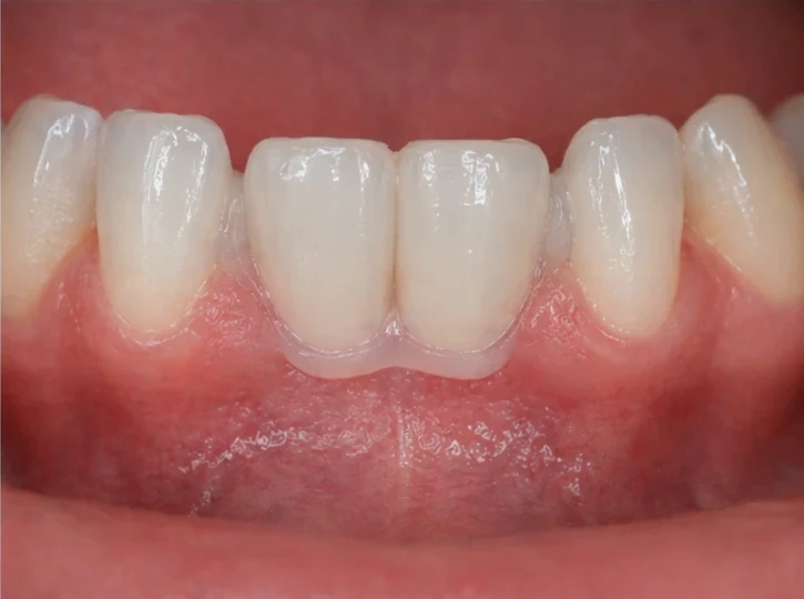 Denticor: sustitución rápida de dos incisivos inferiores: espacio, puente DentiFlex preparado con dos dientes, colocación como una pieza única y resultado
