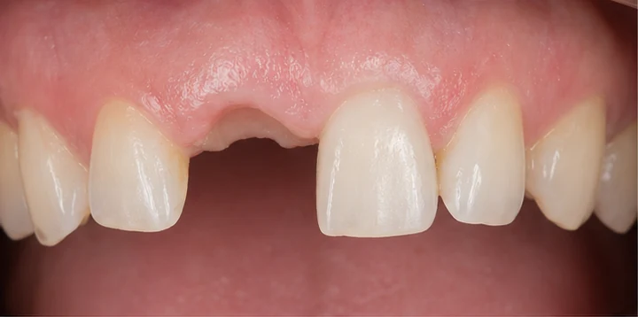 Procedimiento visual para la colocación y el ajuste de la prótesis: premolar inferior