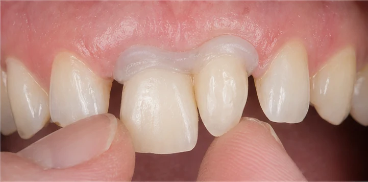 Procedimiento visual para la colocación y el ajuste de la prótesis: premolar inferior